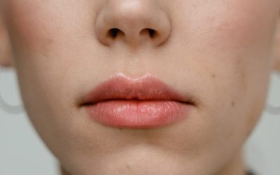 How Long Do Lip Fillers Last ?